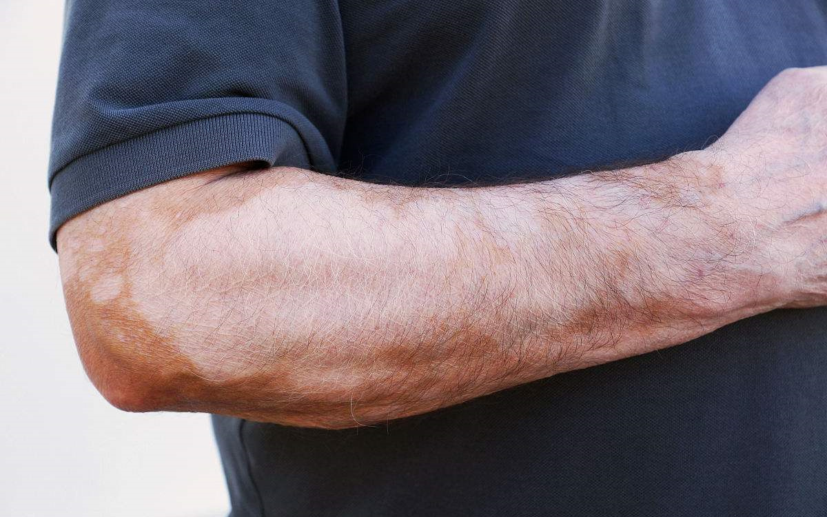 甲醛超標和白癜風有關系嗎？裝修污染對人體影響極大！